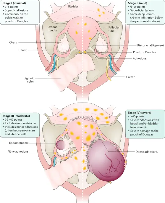 Endometriosis &#8211; wandering mucosa, causes, symptoms, disease detection