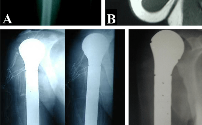 Endoprostheses cheaper than amputation in the treatment of bone cancer