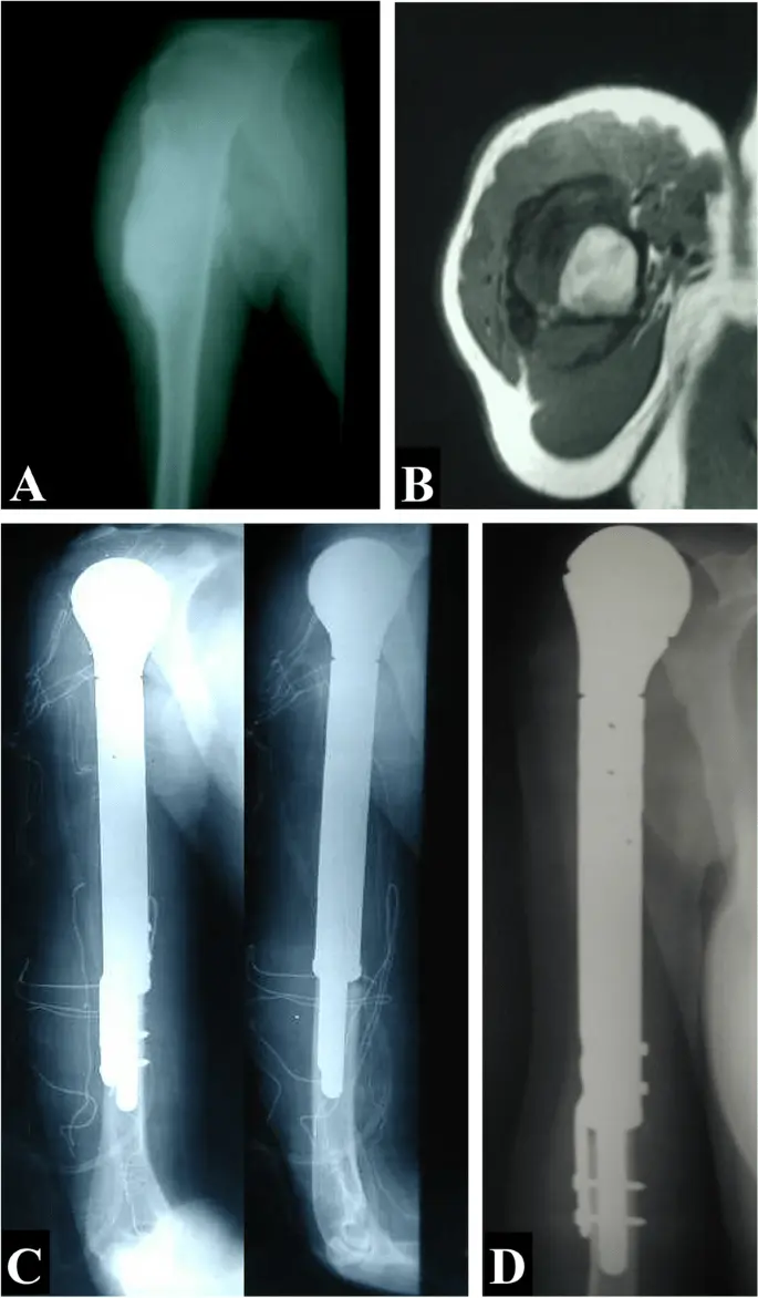 Endoprostheses cheaper than amputation in the treatment of bone cancer