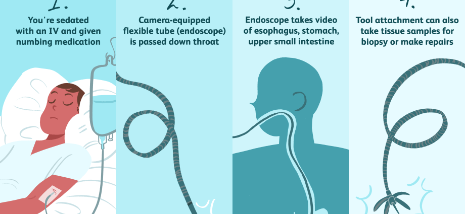 Endoscopic examination of the nose, esophagus and stomach. How to prepare for an endoscopic examination?