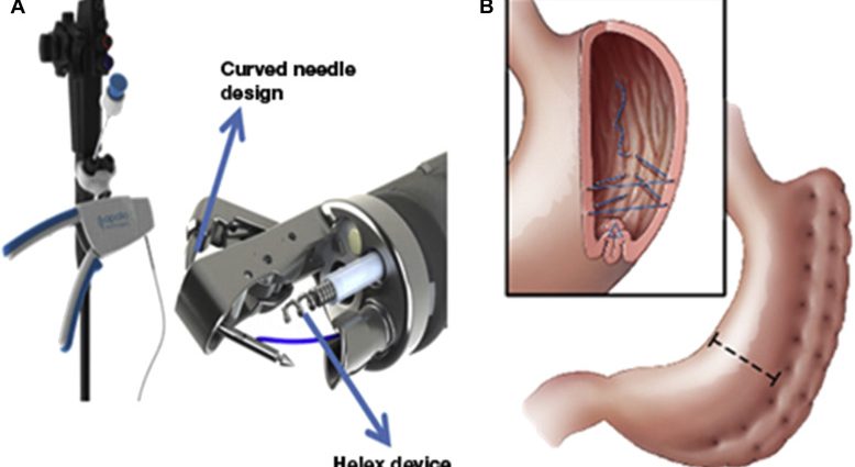 Endoscopic Gastric Reduction (ESG) Overstitch &#8211; what is this method of fighting obesity?