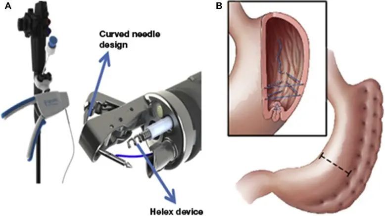 Endoscopic Gastric Reduction (ESG) Overstitch &#8211; what is this method of fighting obesity?