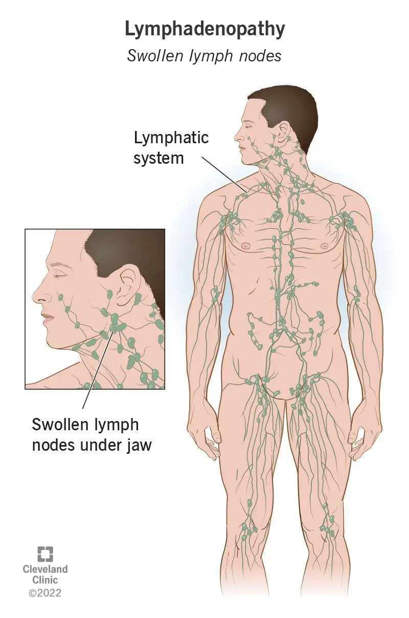 Enlarged lymph nodes &#8211; causes, symptoms, treatment [EXPLAINED]