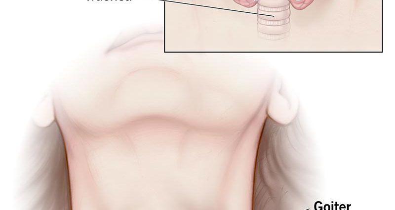 Enlarged thyroid gland &#8211; causes, treatment