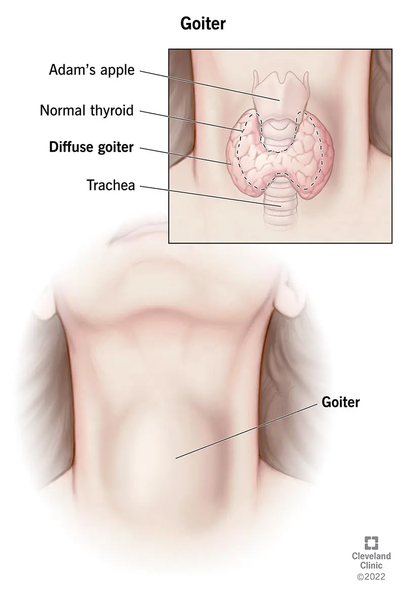 Enlarged thyroid gland &#8211; causes, treatment