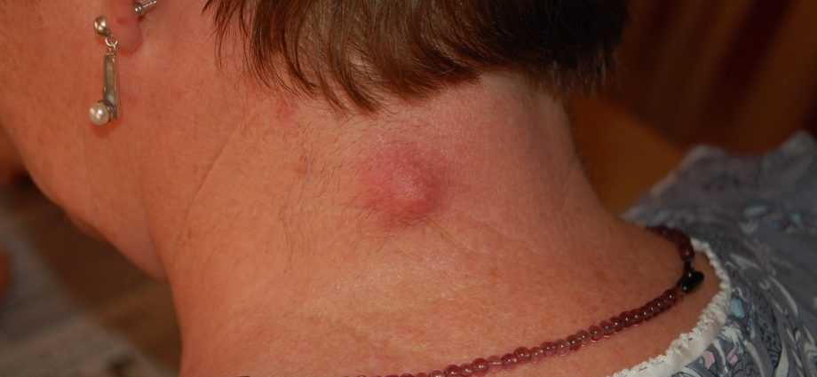 Epidermal (sebaceous) cyst