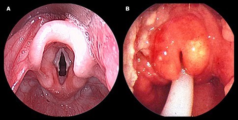 Epiglottitis or epiglottis laryngitis