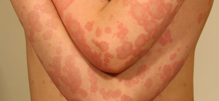 Erythema exudative multiforme &#8211; symptoms and treatment