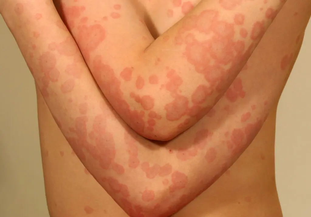 Erythema exudative multiforme &#8211; symptoms and treatment