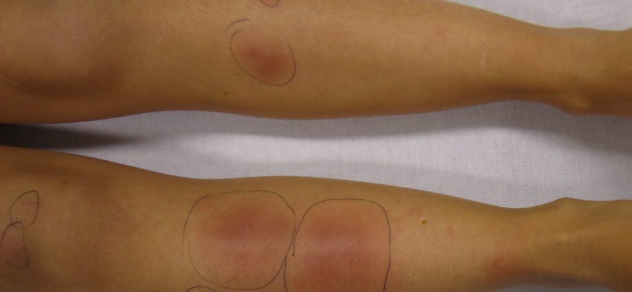 Erythema nodosum &#8211; causes, symptoms, treatment