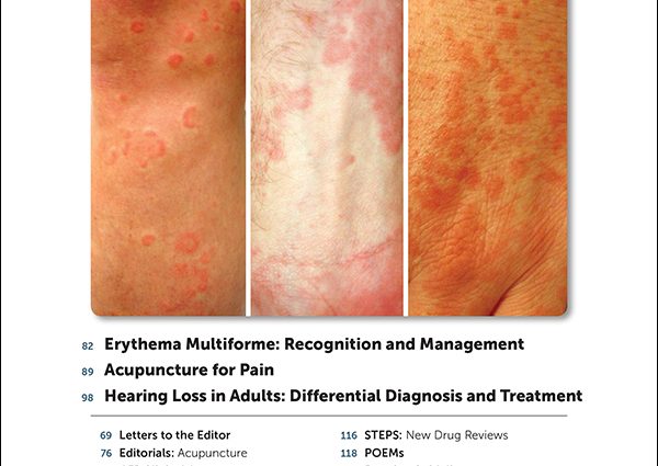 Erythema &#8211; types, symptoms, photos, treatment