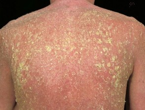 Erythroderma &#8211; generalized dermatitis. Symptoms and Treatment