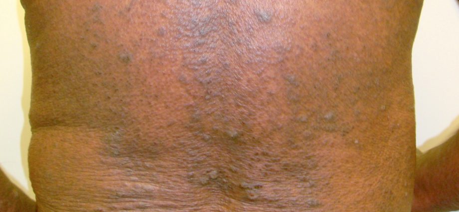 Erythroderma in the course of lichen planus