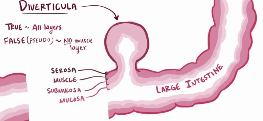 Esica &#8211; diverticula, tumors, polyps