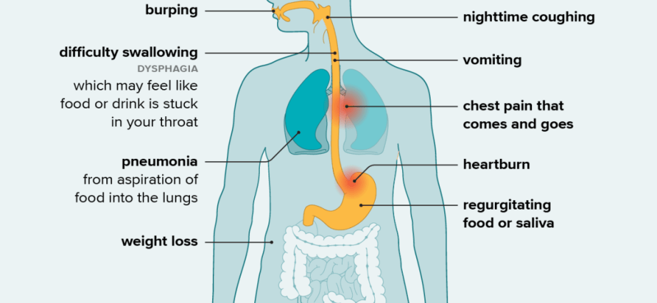 Esophageal Achalasia &#8211; Causes, Symptoms, Treatment