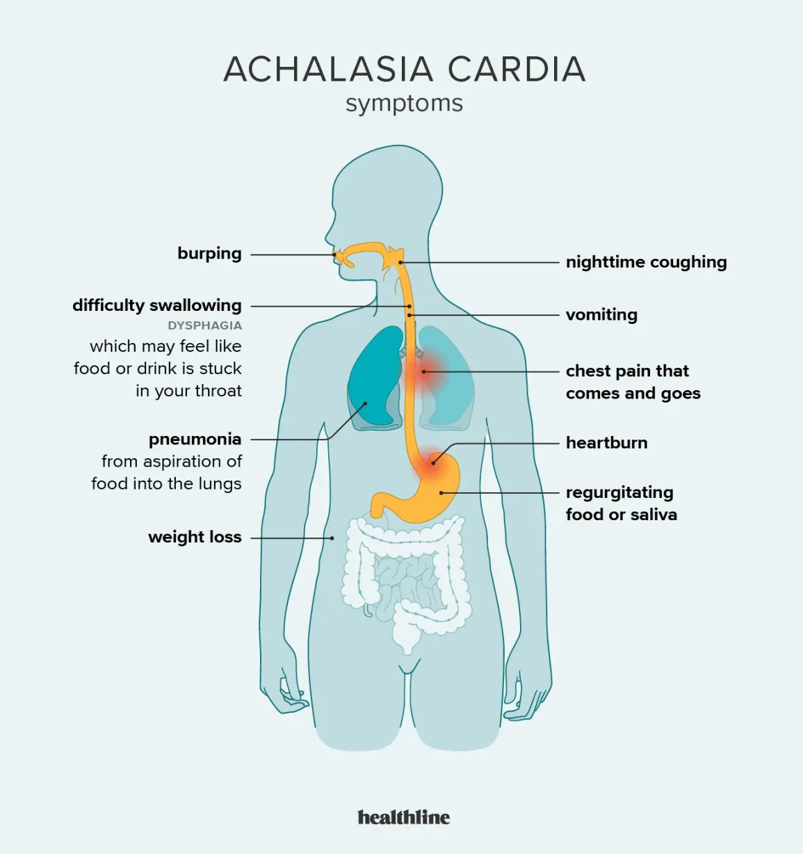 Esophageal Achalasia &#8211; Causes, Symptoms, Treatment