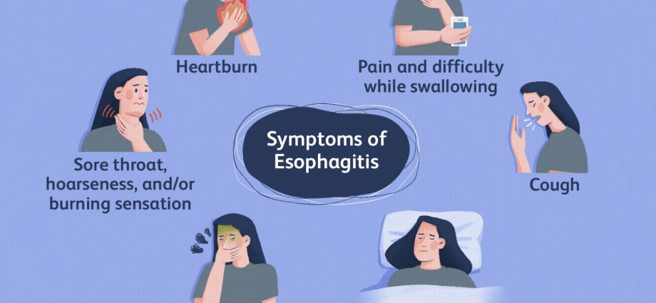 Esophagitis &#8211; causes, symptoms. What types of esophagitis are there?