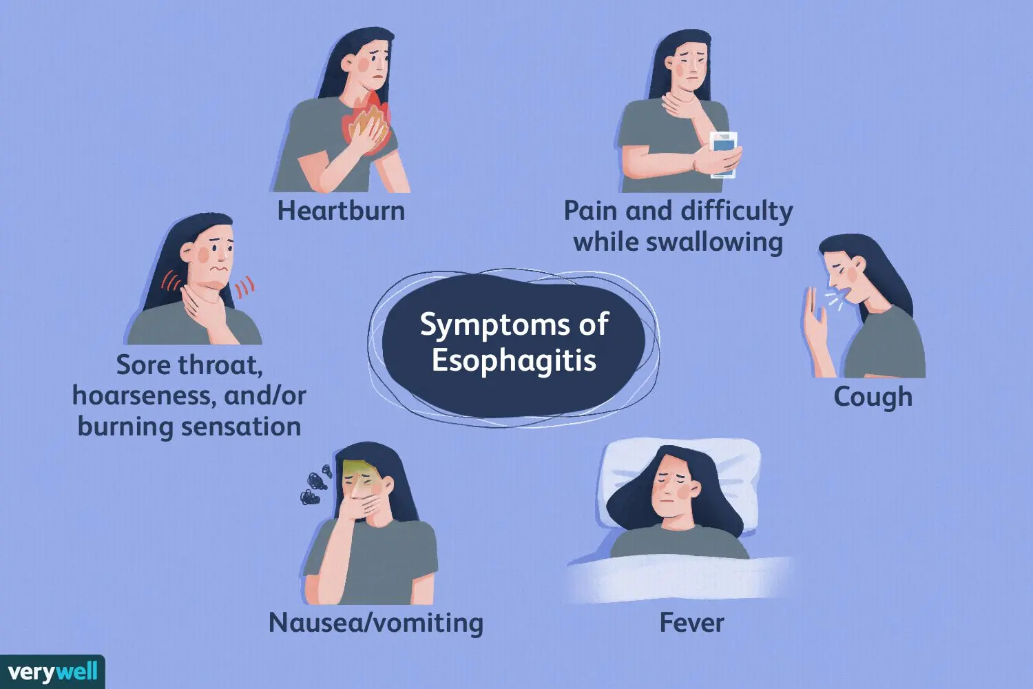 Esophagitis &#8211; causes, symptoms. What types of esophagitis are there?