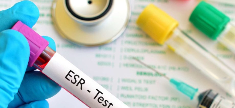 ESR (Biernacki test) &#8211; when to do the test? OB standards