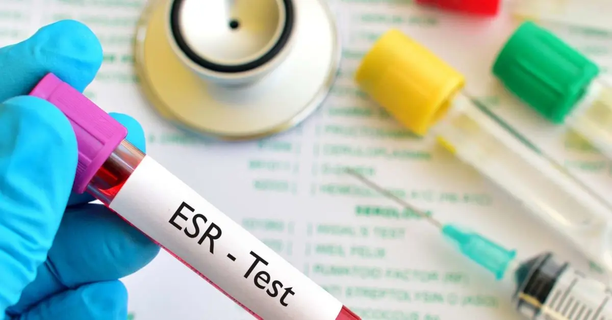 ESR (Biernacki test) &#8211; when to do the test? OB standards