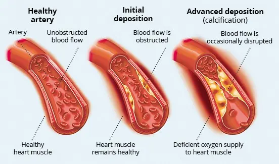 Even slightly elevated cholesterol can cause a heart attack