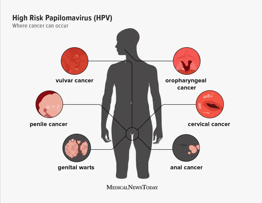 Every second man infected with the human papillomavirus (HPV)