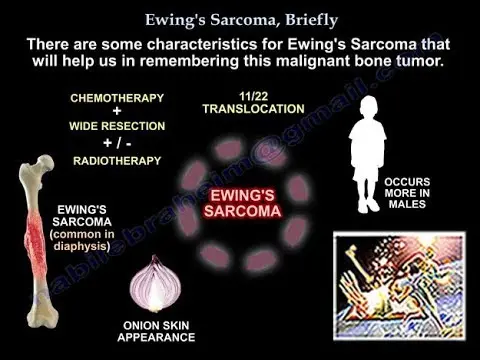 Ewing&#8217;s sarcoma &#8211; description, diagnosis, symptoms, treatment