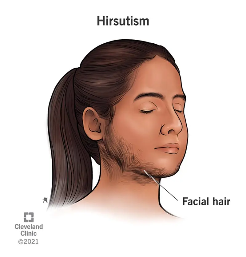 Excessive facial hair &#8211; could it be hirsutism?