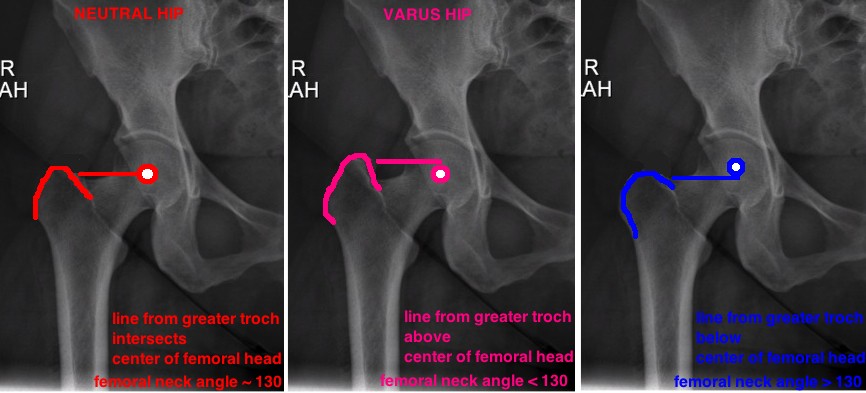 Exfoliation of the femoral head (juvenile varus hip)