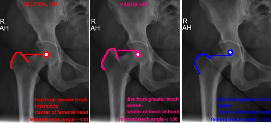 Exfoliation of the femoral head (juvenile varus hip)