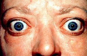 Exophthalmos &#8211; types, causes, symptoms, diagnosis, treatment