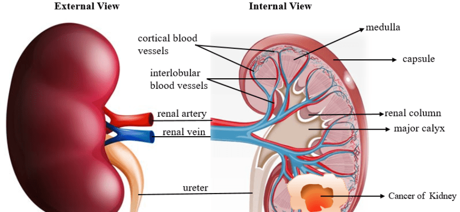 Expert: Kidney cancer is usually detected by random examinations