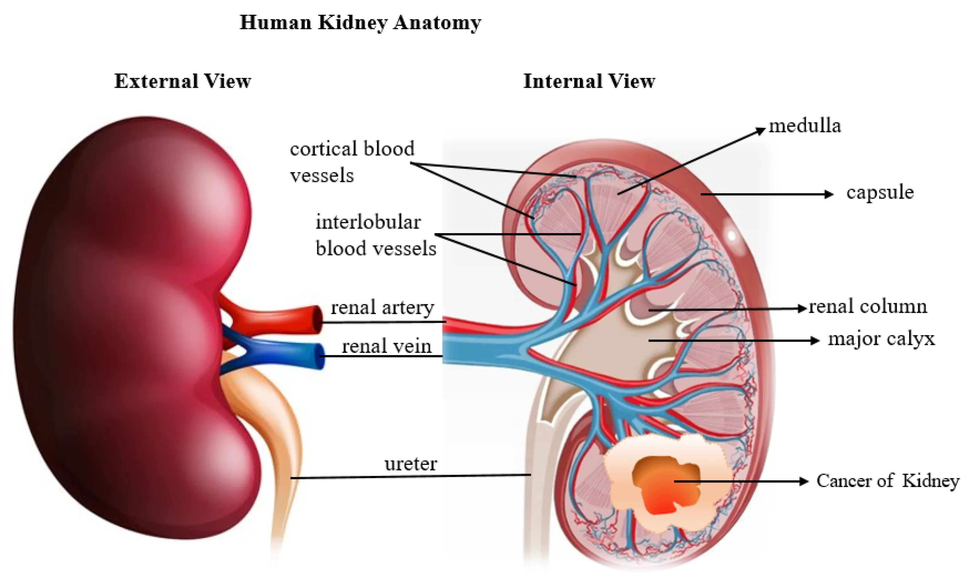 Expert: Kidney cancer is usually detected by random examinations