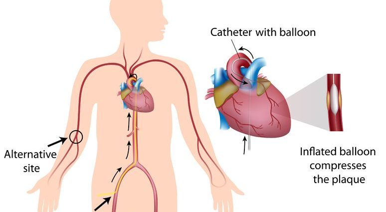 Extended angioplasty