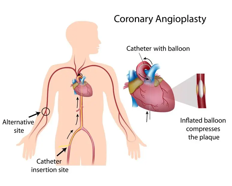 Extended angioplasty