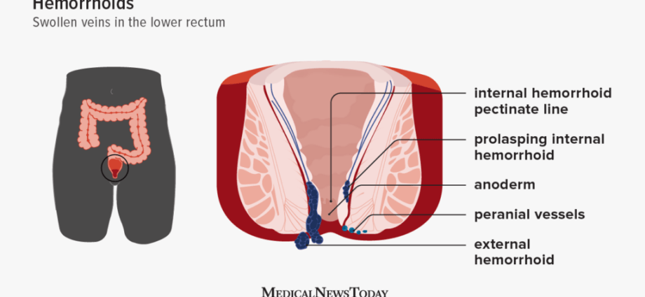 External hemorrhoids &#8211; causes, symptoms. Treatment of external hemorrhoids