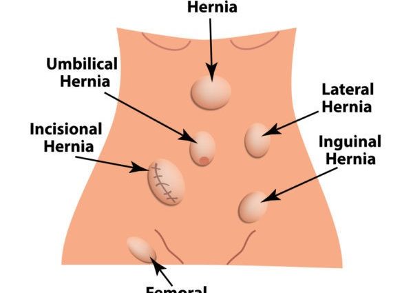 External hernias &#8211; when to see a doctor, diagnosis, pre-medical treatment