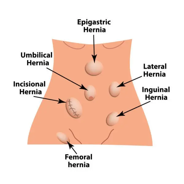 External hernias &#8211; when to see a doctor, diagnosis, pre-medical treatment