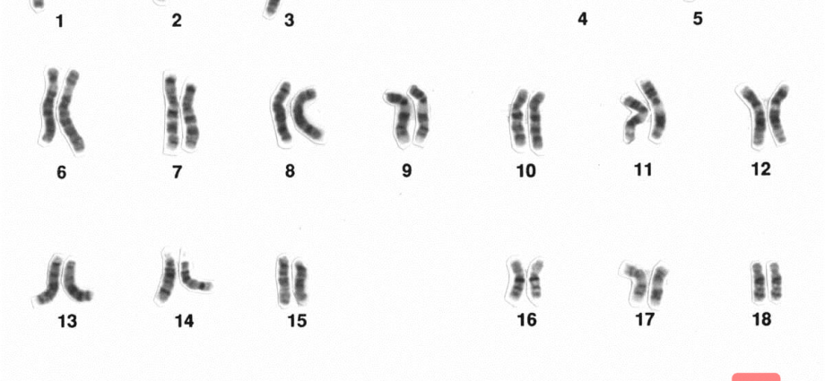 Extra X chromosome in boys and girls. What could be the cause?