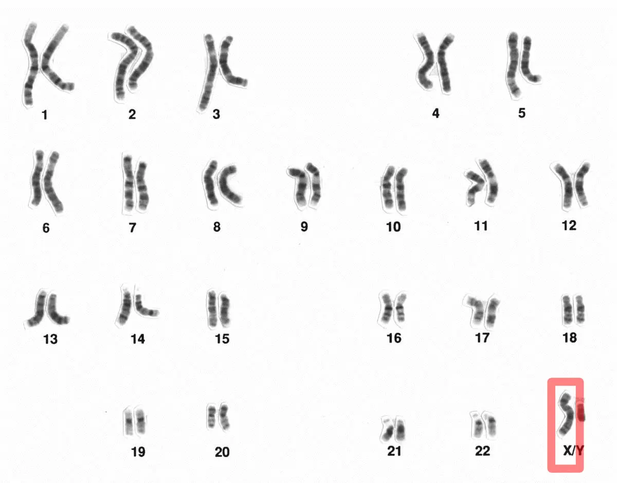 Extra X chromosome in boys and girls. What could be the cause?