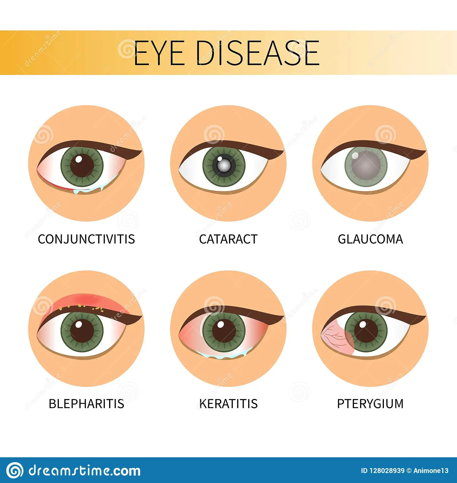 Eye diseases