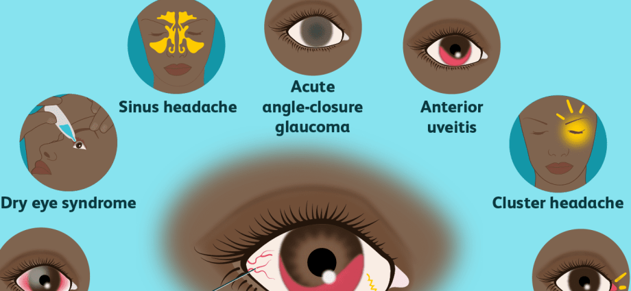 Eye pain. Diseases that are manifested by pain in the eyeball