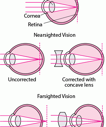 Eye refraction &#8211; what is it? How much is the eye refraction?