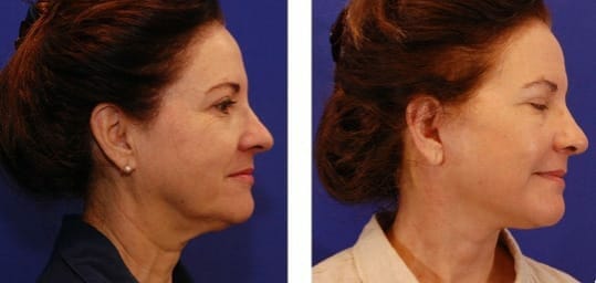 Face lifting &#8211; types of facelift, description of treatments, effects