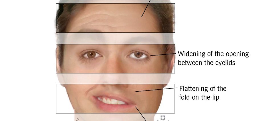 Facial nerve palsy &#8211; causes, symptoms and treatment