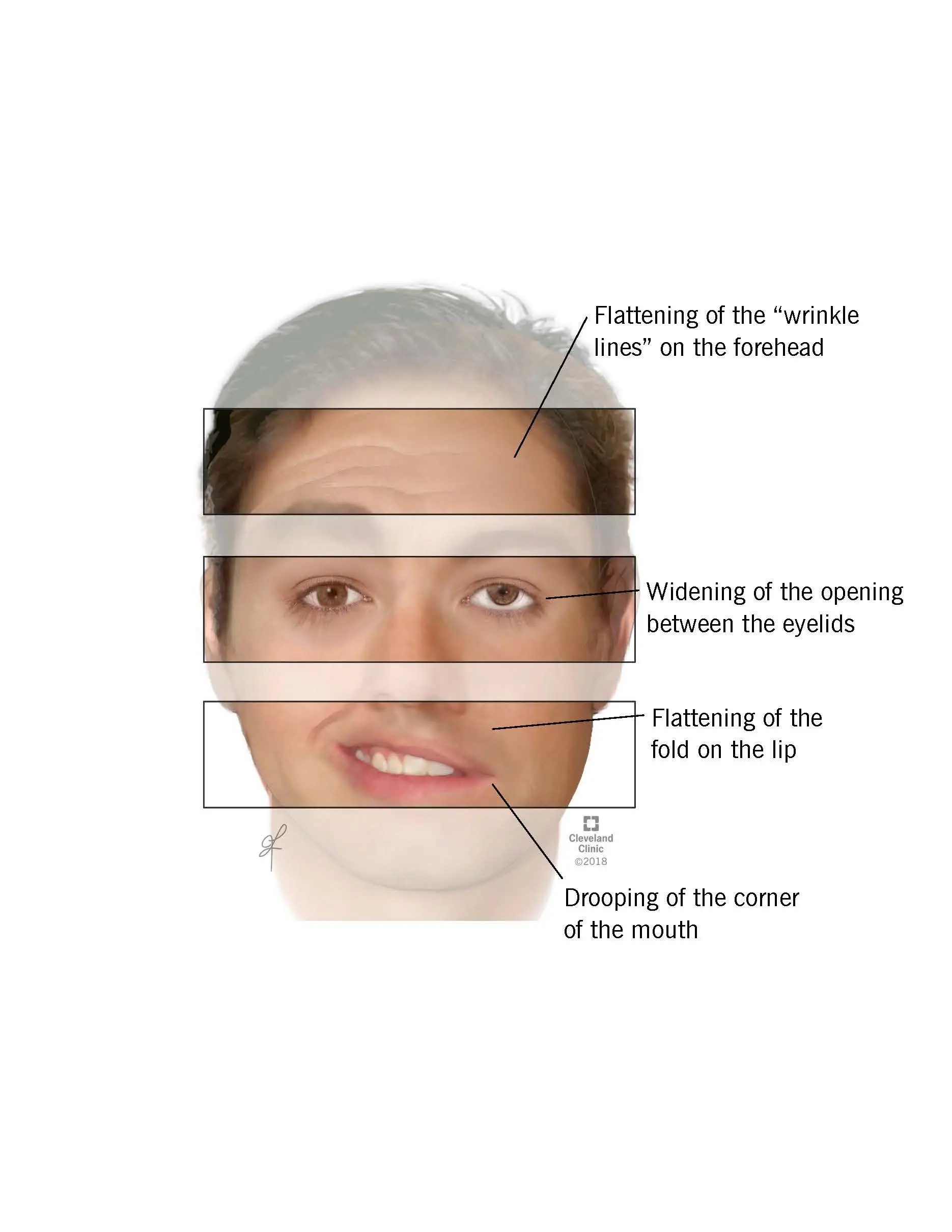 Facial nerve palsy &#8211; causes, symptoms and treatment