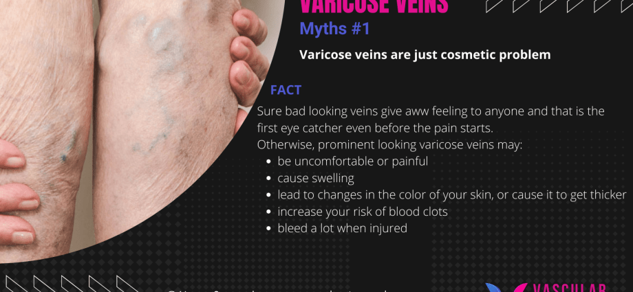 Facts and myths about varicose veins