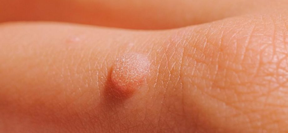 Facts and myths about warts. How to treat warts?