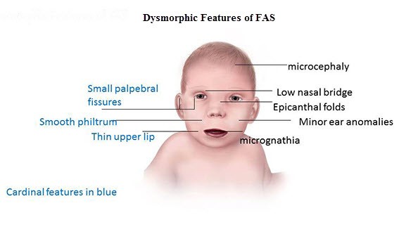 FAS syndrome &#8211; causes, symptoms, treatment. Childcare with FAS