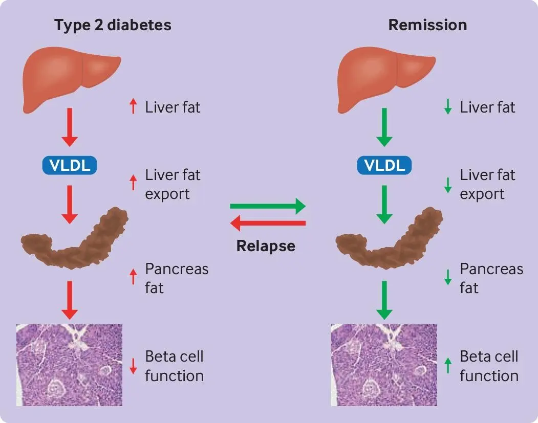 Fat cells are the main culprits of type 2 diabetes